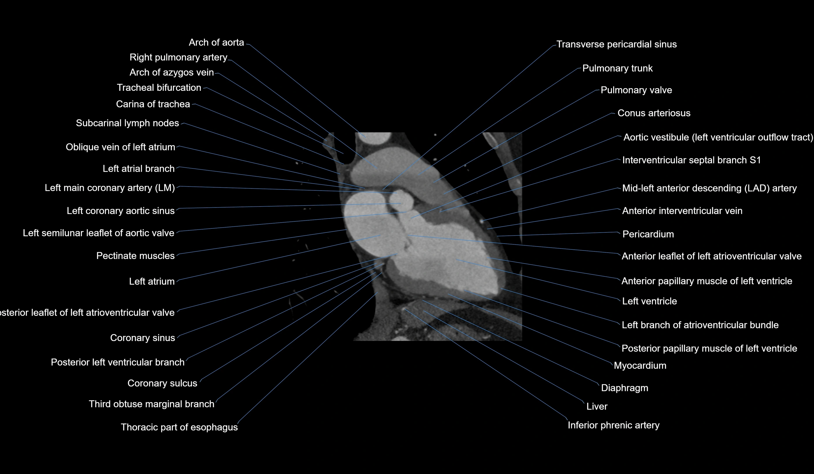 CT heart (coronary angiogram) 2 chamber view cross sectional anatomy labelled radiology image-00018.webp